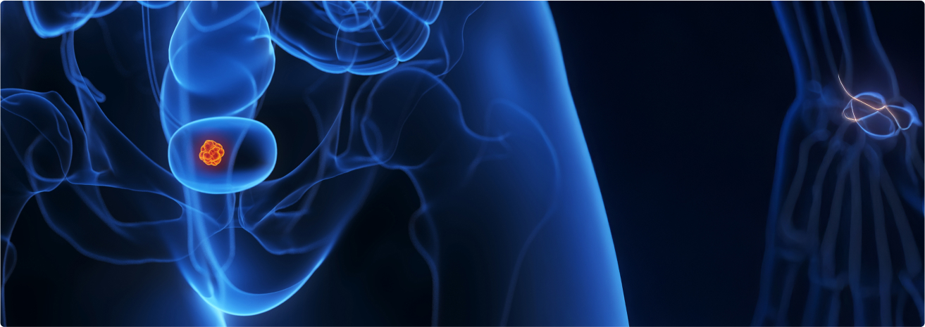 Bladder Cancer