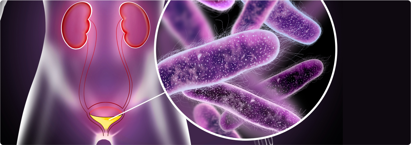 Risk Factors for bladder cancer