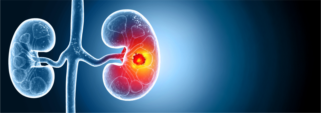 Kidney Cancer