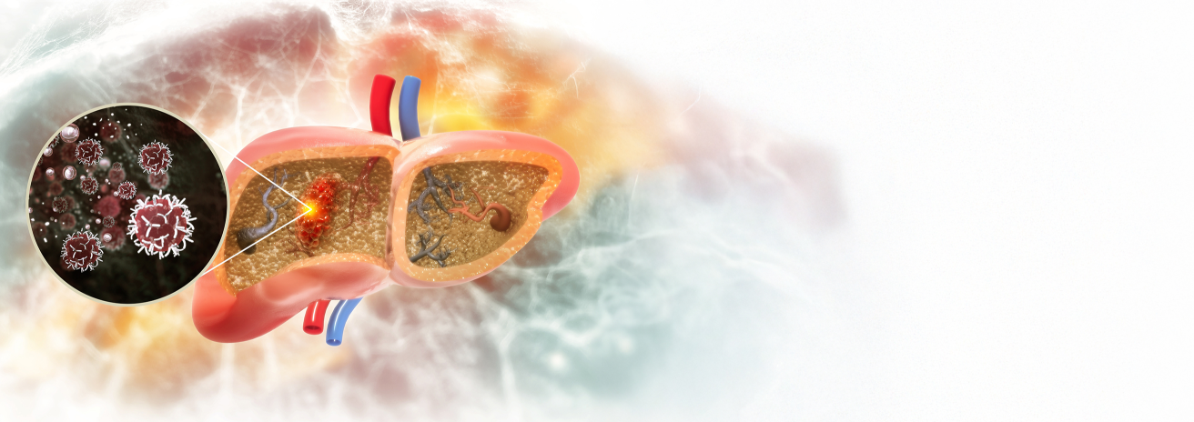 Liver Cancer