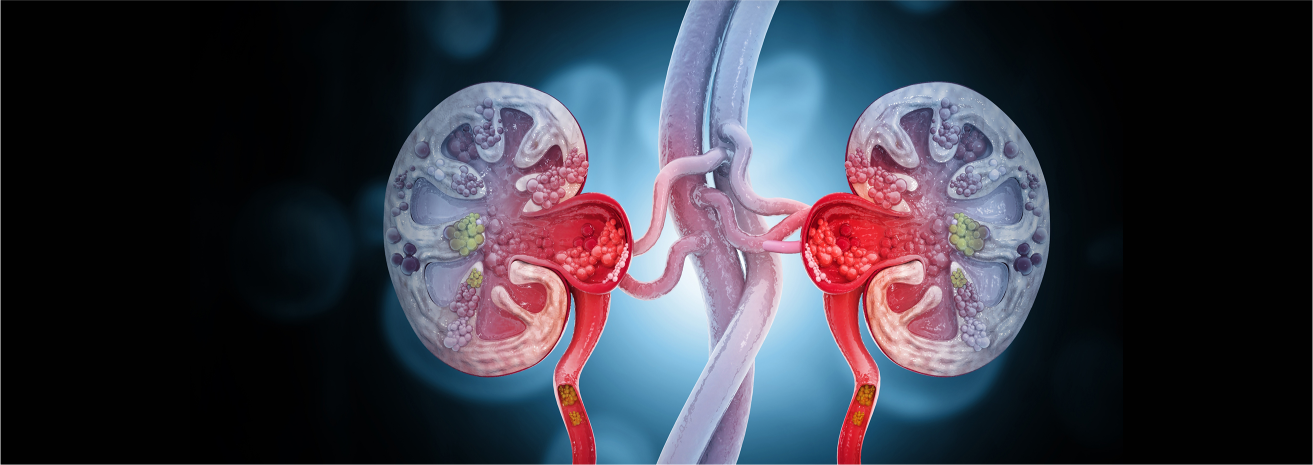 Risk Factors for Kidney Cancer include