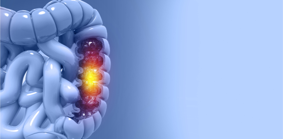Colorectal Cancer