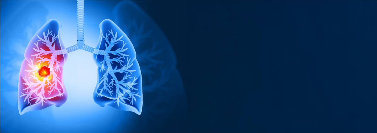 Lung Cancer