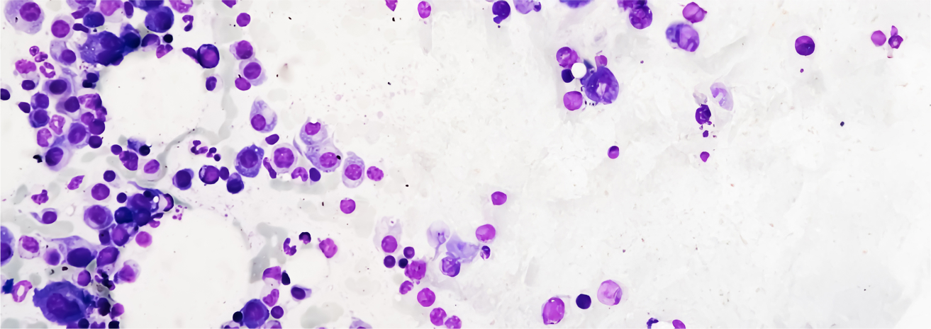 Multiple Myeloma Cancer