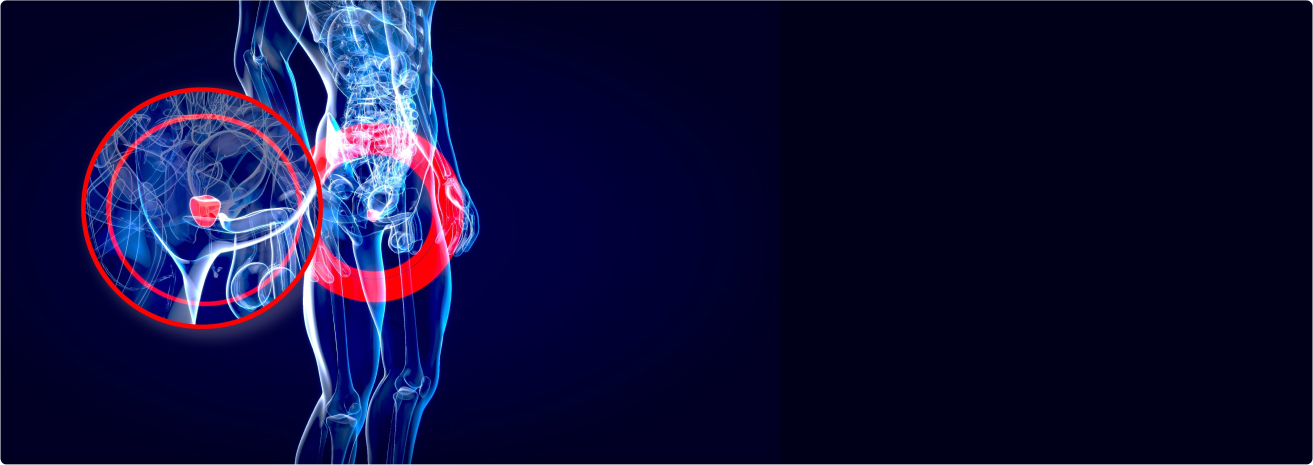 Prostate Cancer