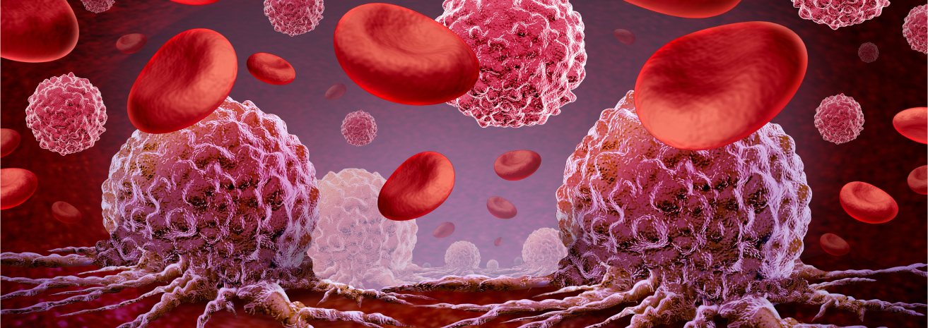 Lymphoma Cancer
