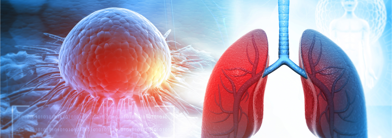 Risk Factors for lung cancer include