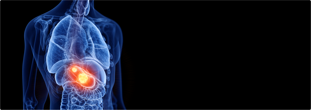 Stomach (Gastric) Cancer